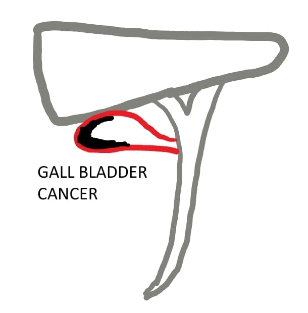 GallBladderCancer