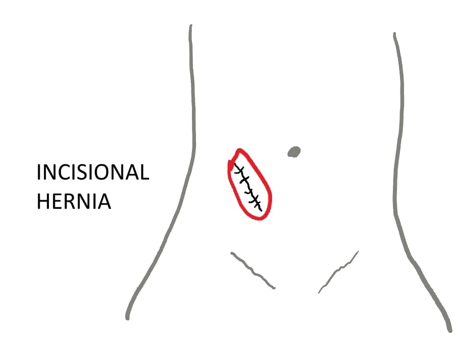Incisional Hernia Treatment in Hyderabad