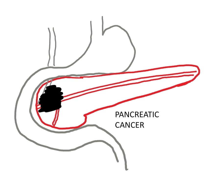 Pancreatic Cancer