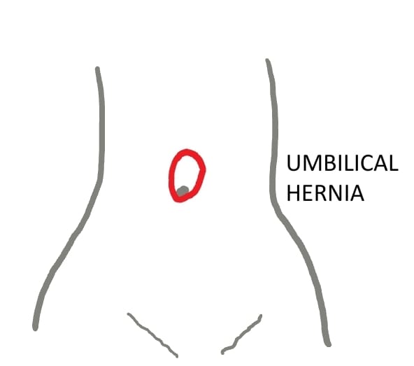 Diagram showing Umbilical Hernia