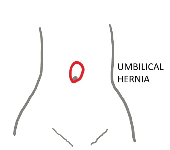 Femoral Hernia Treatment in Hyderabad - Dr. K V Dinesh Reddy