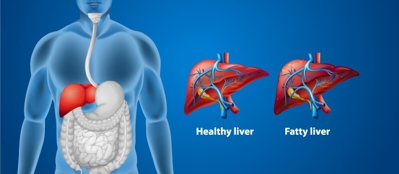 Diagram showing non-alcoholic fatty liver dsease