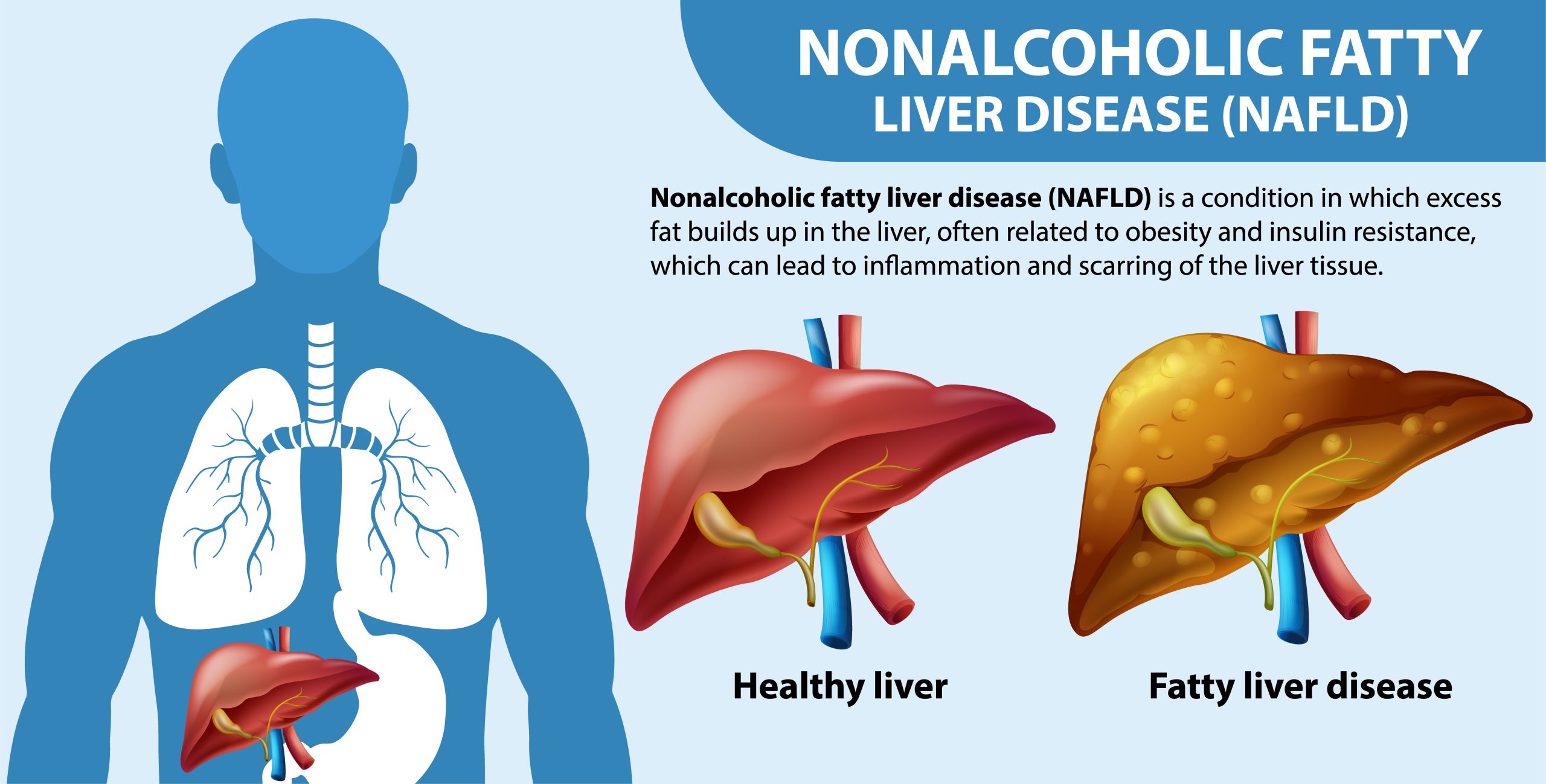 Infographic about Non-alcoholic liver disease