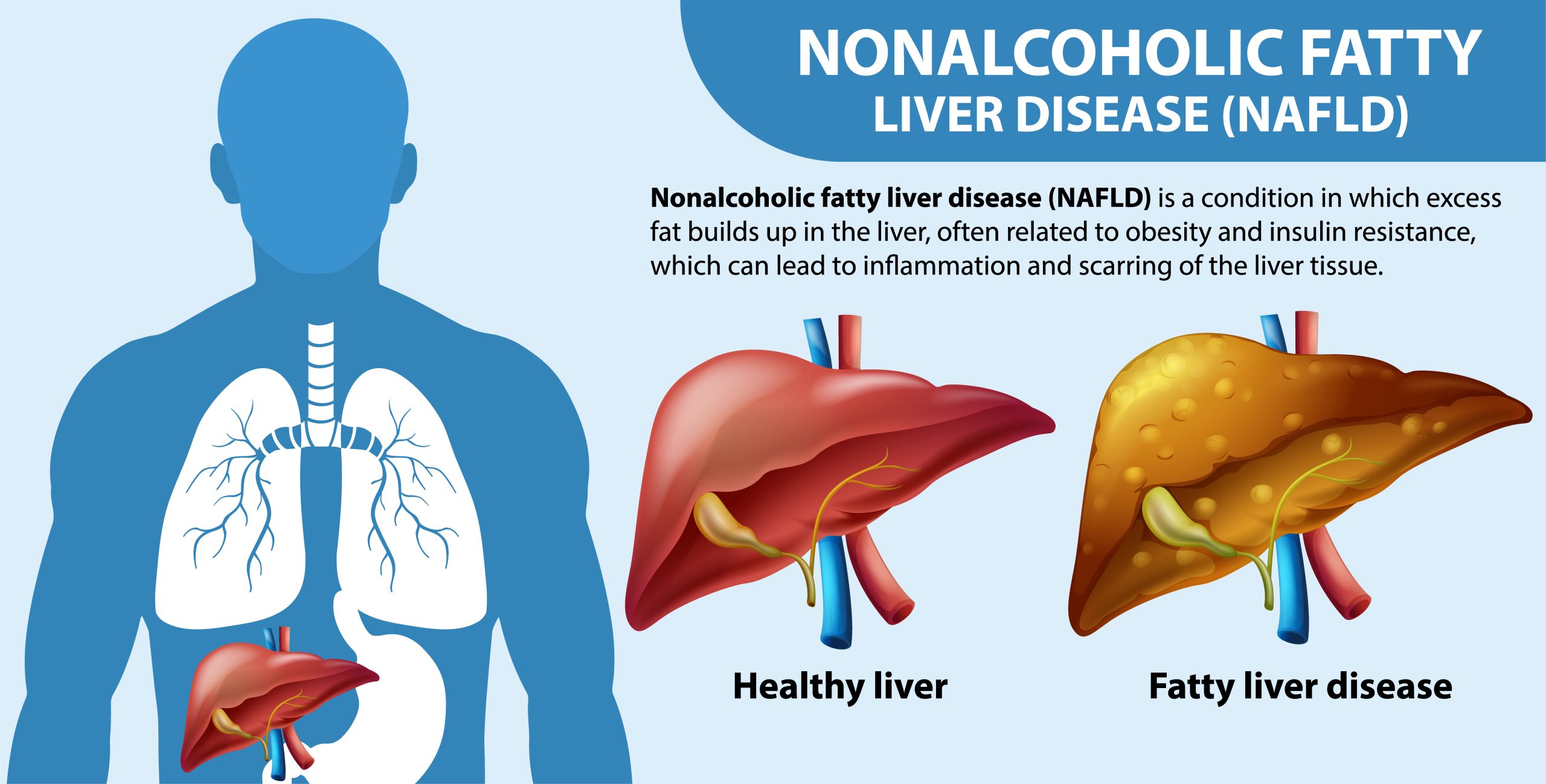 Fatty Liver Treatment in Hyderabad - Dr. K V Dinesh Reddy