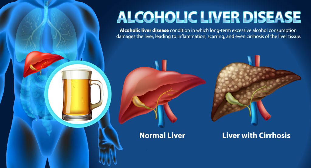 Diagram showing alcoholic liver disease