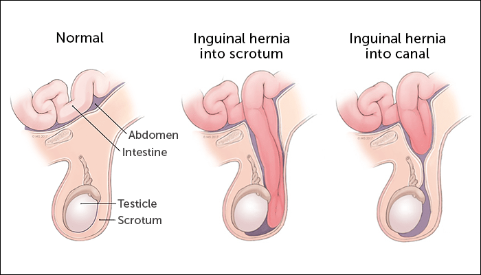 Infographic about the development process of Inguinal Hernia