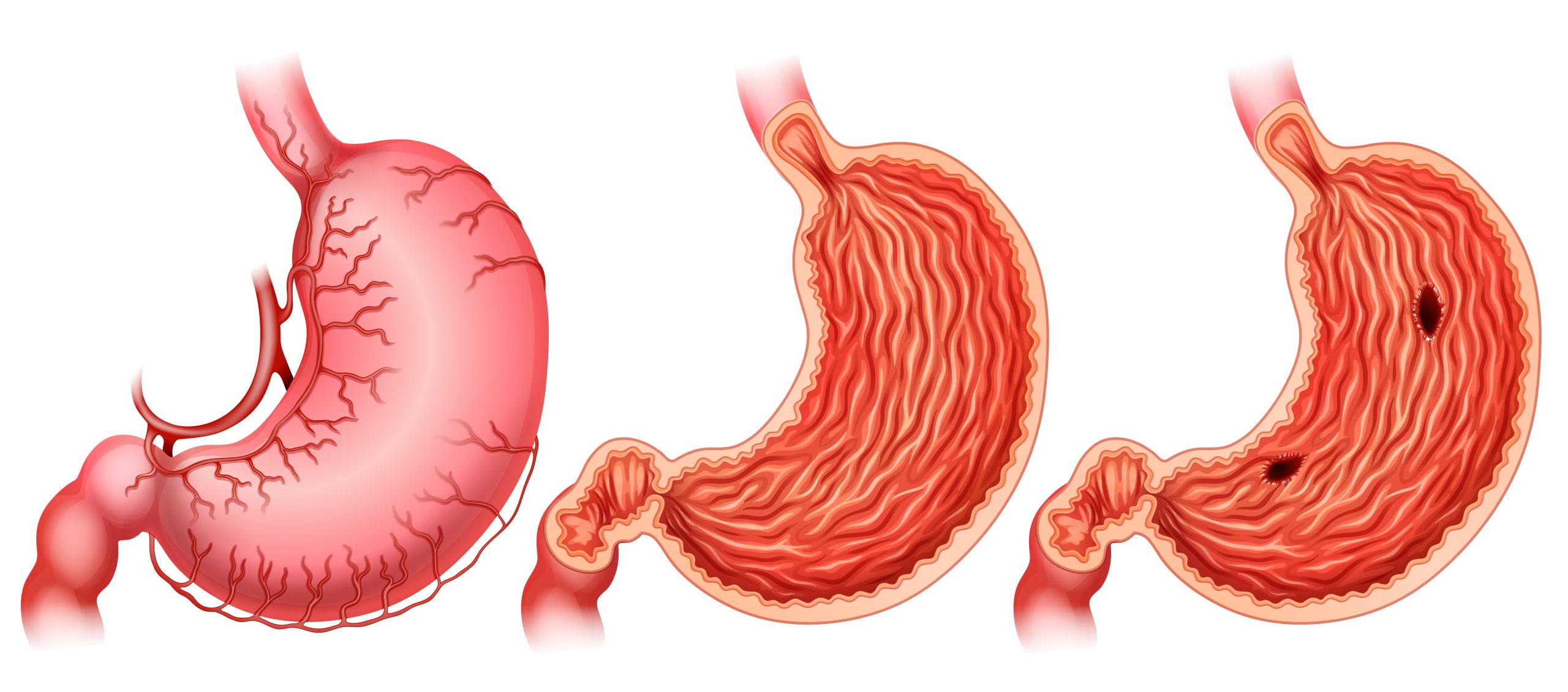 linear image of a stomach showing the development of gastric cancer in three stages