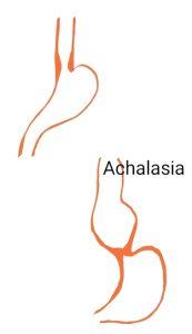 Diagram showing Achalasia Cardia