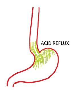 Diagram showing acid reflux