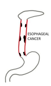 Diagram showing esophageal cancer