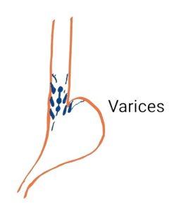 Diagram showing Varices