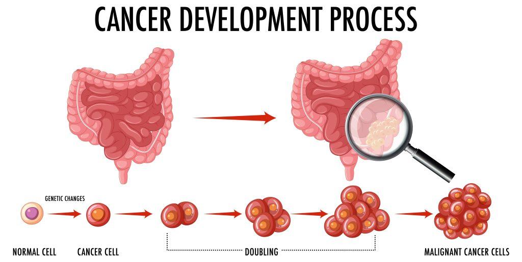 Diagram showing colorectal cancer development process