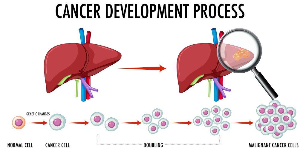 Diagram showing liver cancer development process