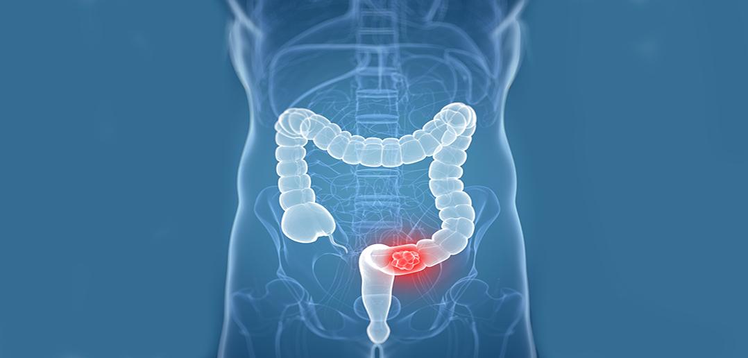 Diagram showing Colorectal Cancer