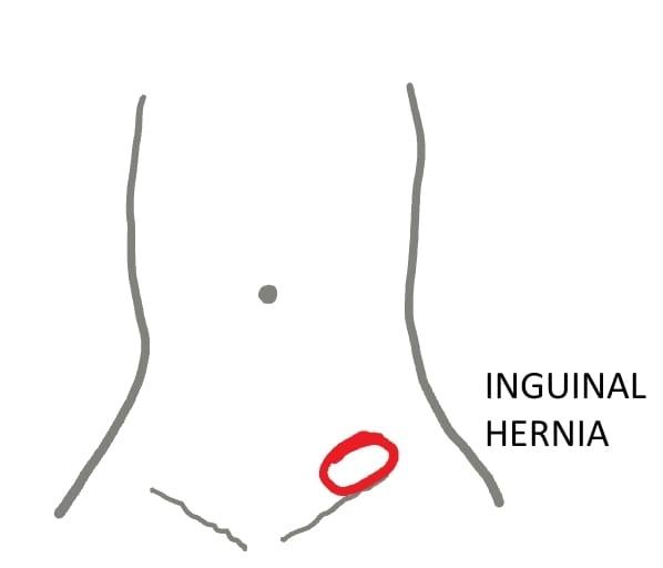 Diagram showing Inguinal Hernia