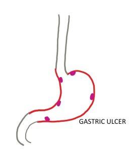 Diagram showing Stomach Ulcer