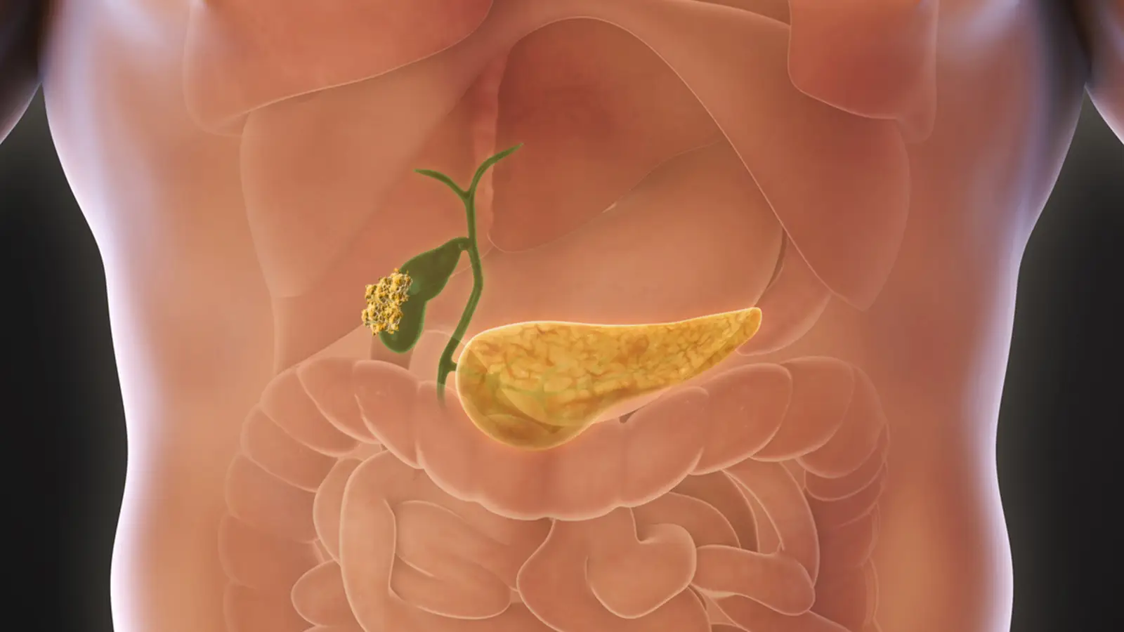 Image of gallbladder cancer