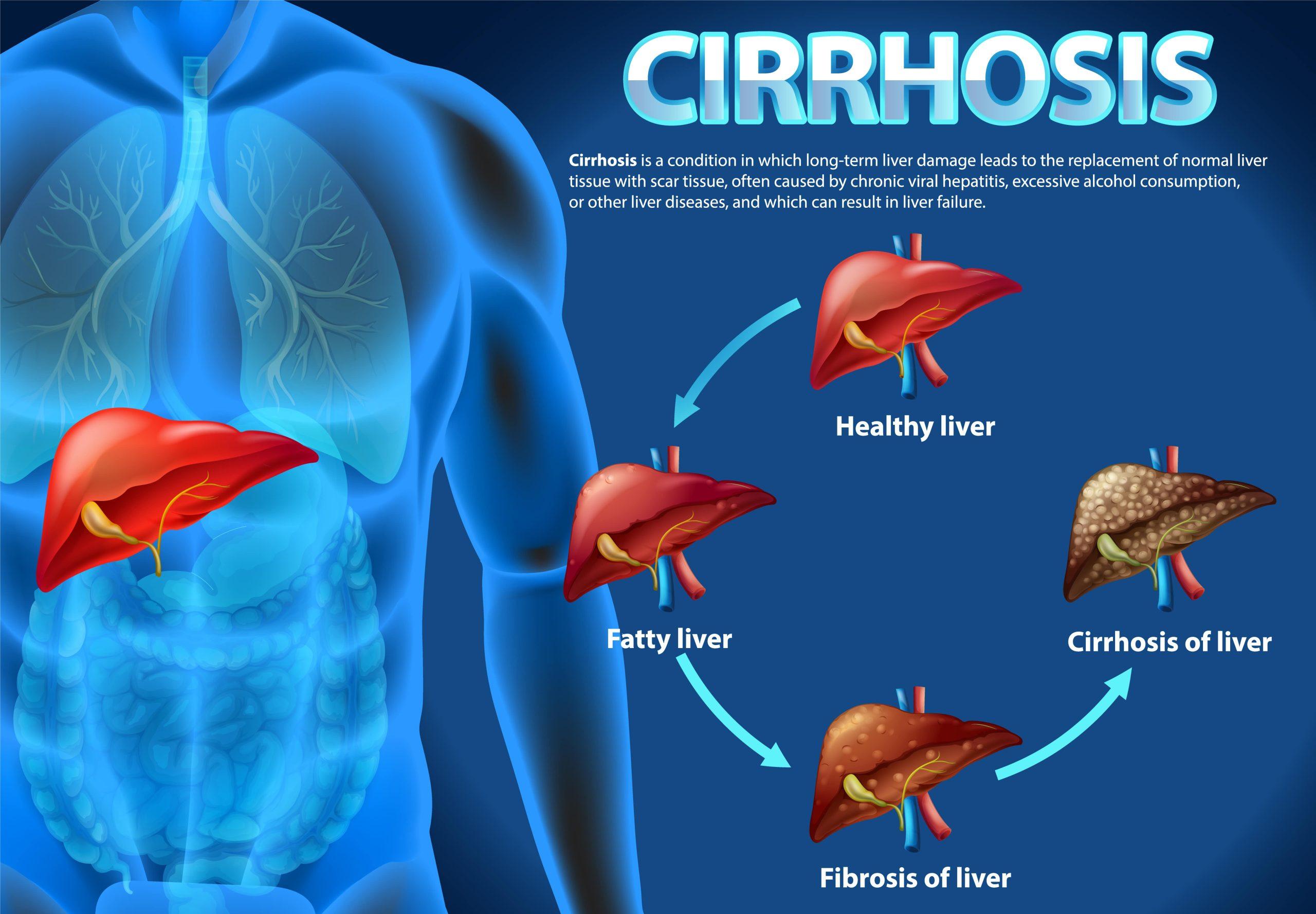 Process of Liver cirrhosis