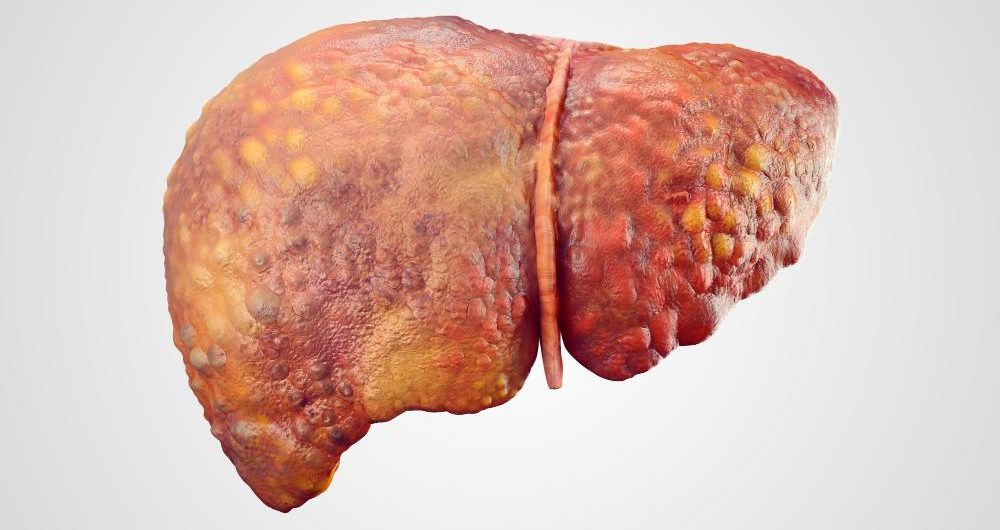 Image of a liver with liver cirrhosis