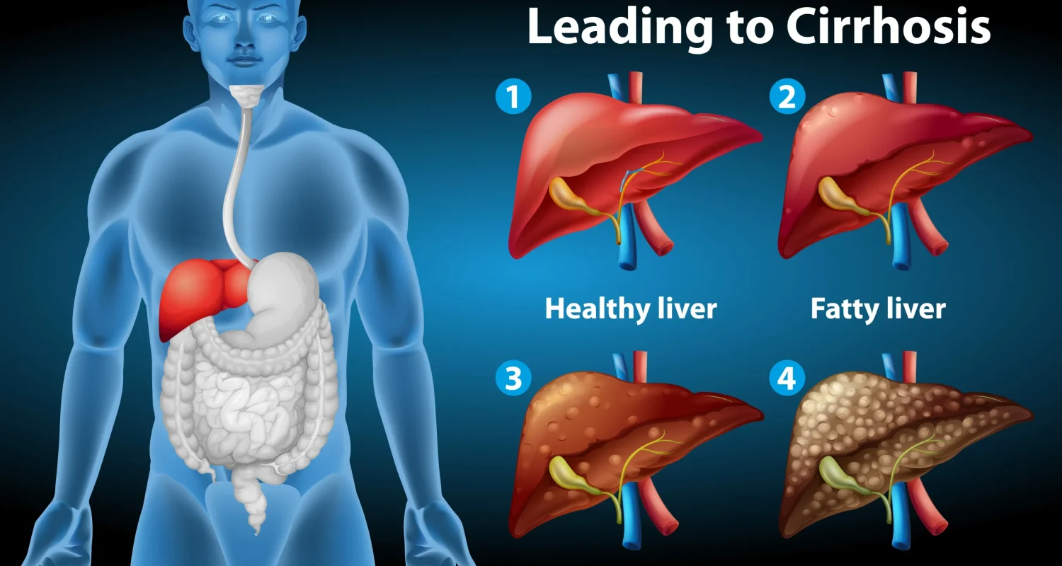 Factors Influencing the Progression of Cirrhosis